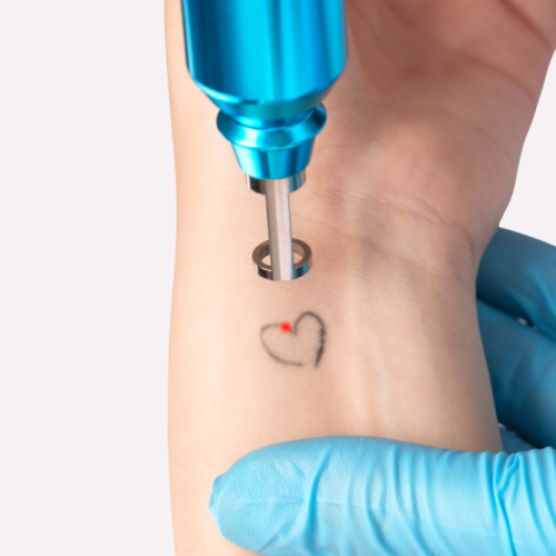 tatoo remove 3 tatoo remove 3