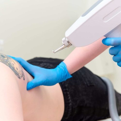 tattoo-removal-in-the-clinic-2021-09-02-02-46-24-utc-scaled-e1638355155732
